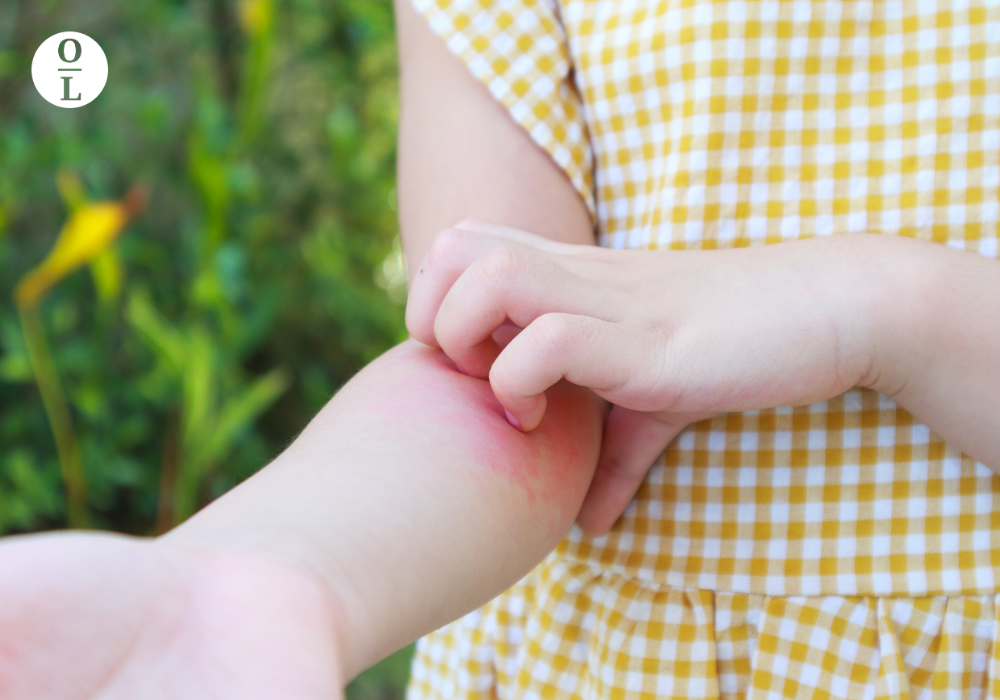 The Top 5 Best Essential Oils For Hives